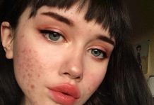 Οι συμβουλές διάσημων δερματολόγων, για την αντιμετώπιση της ακμής