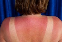 Oh, are you burnt? Ways of relief exist!