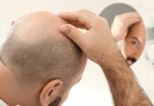 Καράφλα ή φαλάκρα υπάρχει θεραπεία; Καράφλα