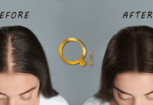 Redensyl εναντίον Minoxidil : Ο απόλυτος οδηγός για θεραπείες κατά τριχόπτωσης