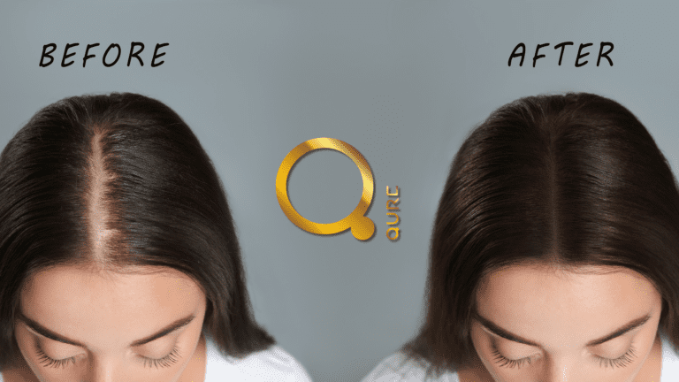 Redensyl εναντίον Minoxidil : Ο απόλυτος οδηγός για θεραπείες κατά τριχόπτωσης
